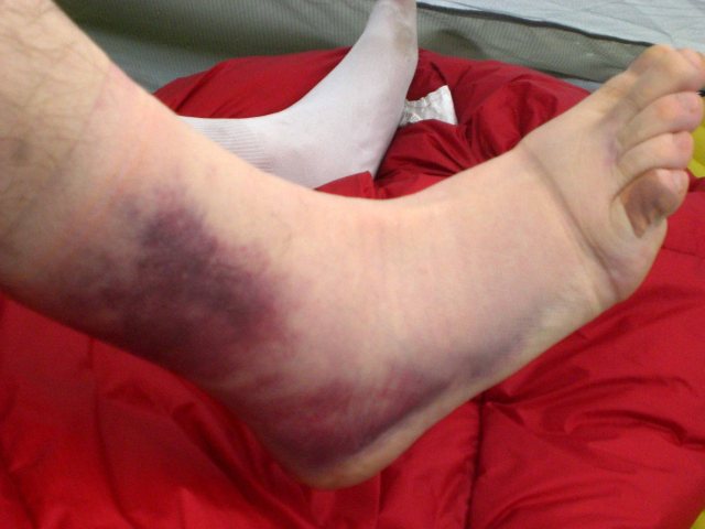 Alaska Chilkoot Trail Trip - Ankle Injury